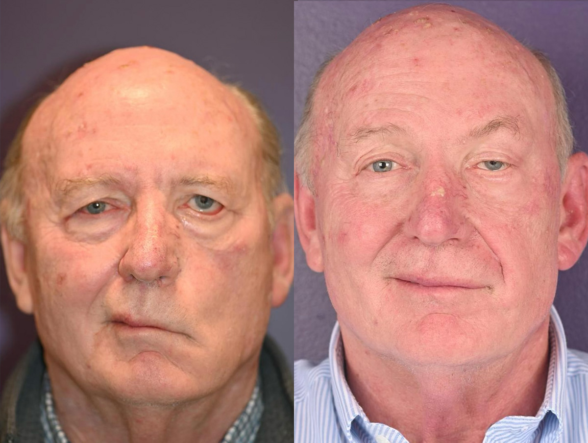 Static Suspension  Before & After Gallery - Patient 136769 - Image 1