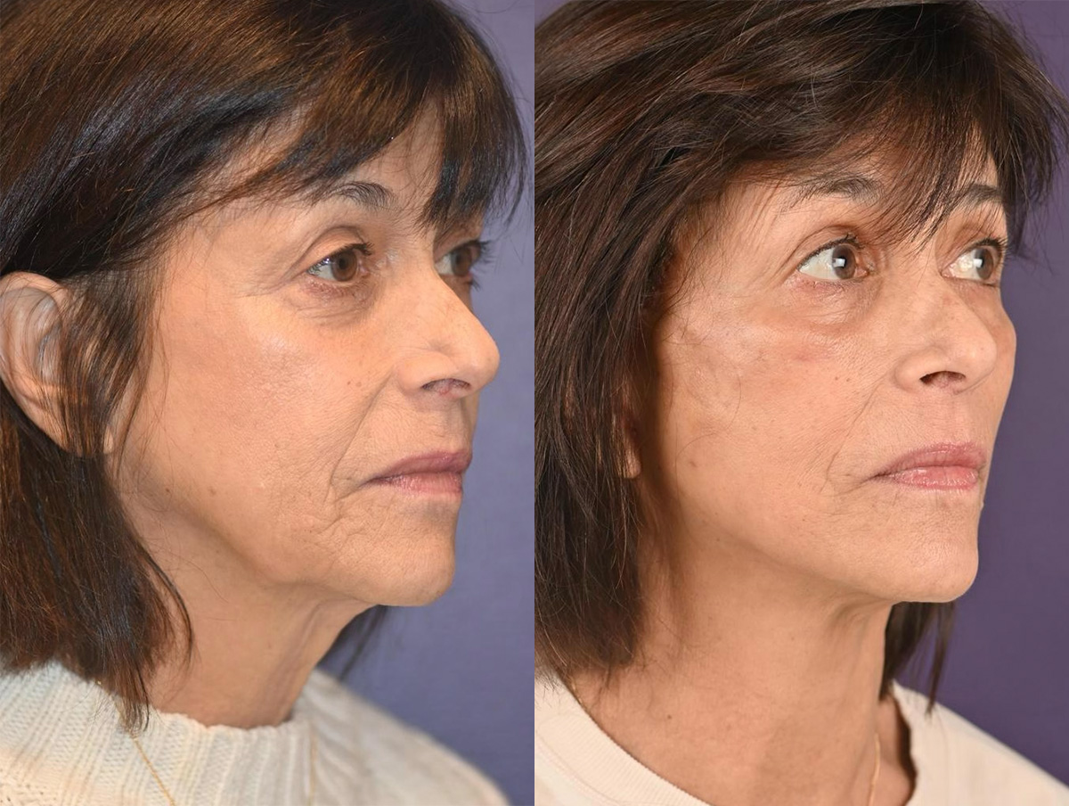 Office Facelift Before & After Gallery - Patient 275212 - Image 1