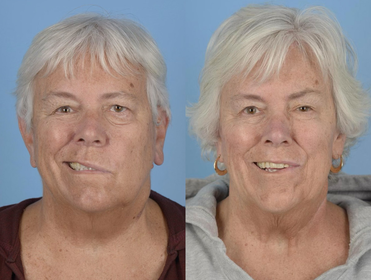 Facial Nerve Repair Before & After Gallery - Patient 854077 - Image 1