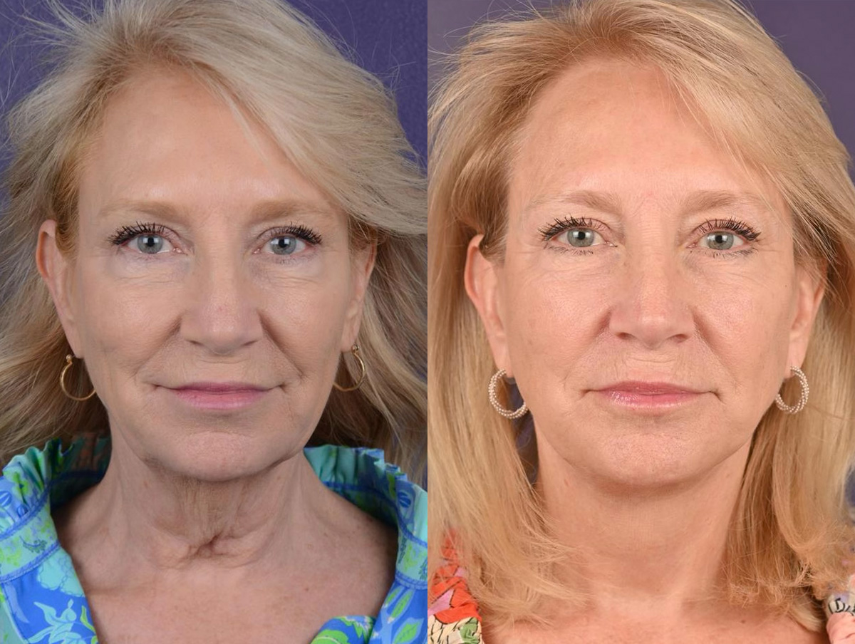 Office Facelift Before & After Gallery - Patient 669080 - Image 1