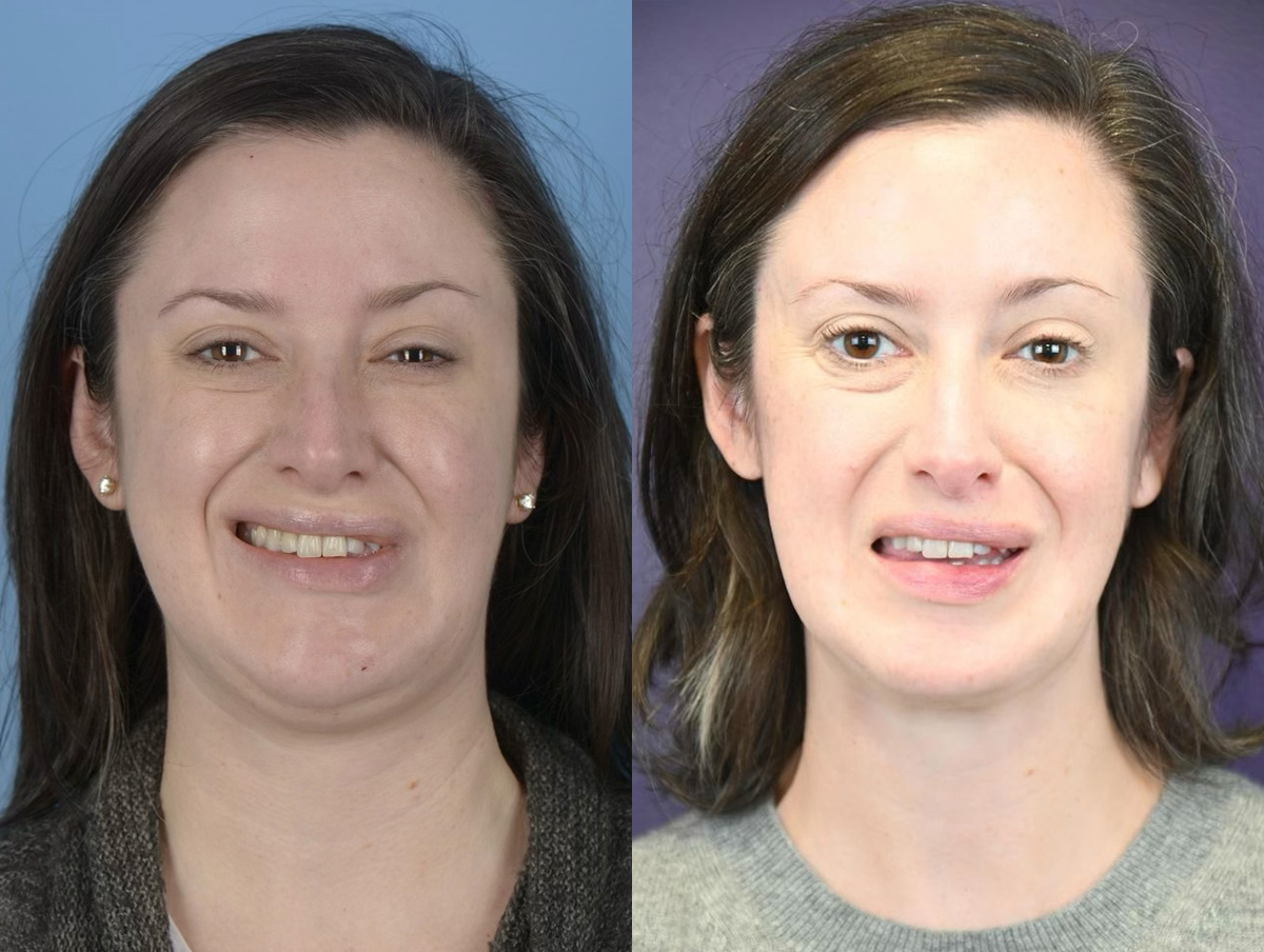 Denervation Before & After Gallery - Patient 214234 - Image 1
