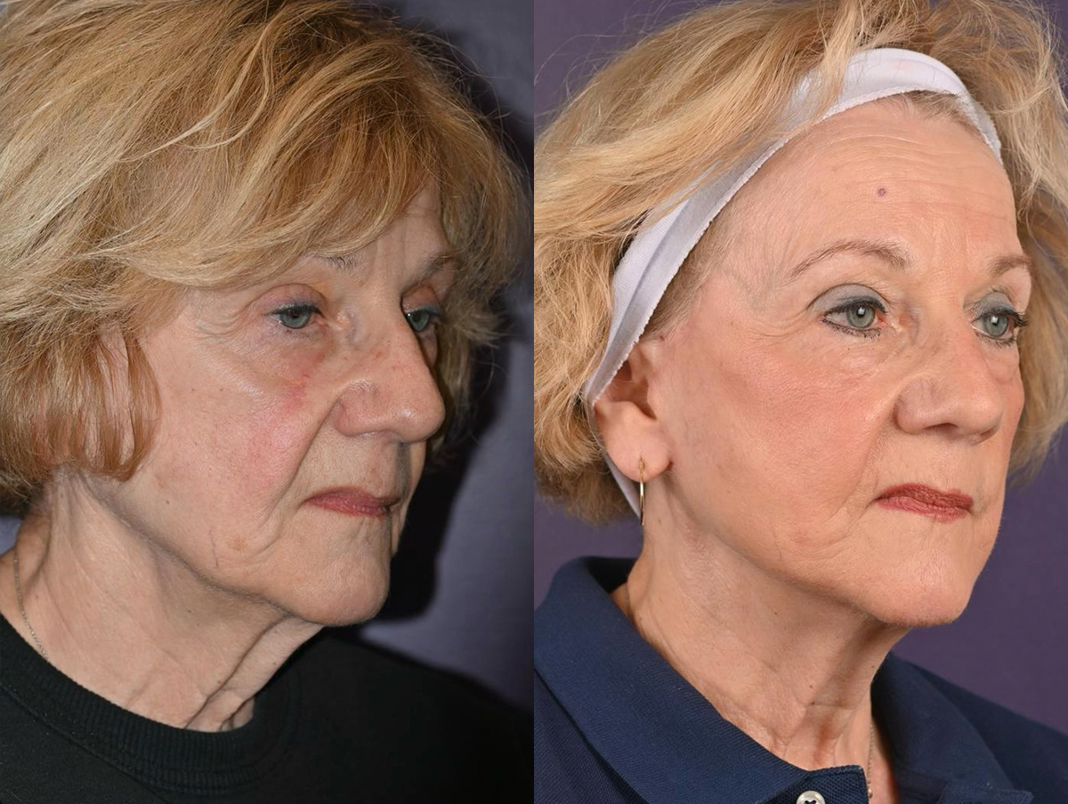 Office Facelift Before & After Gallery - Patient 421816 - Image 1