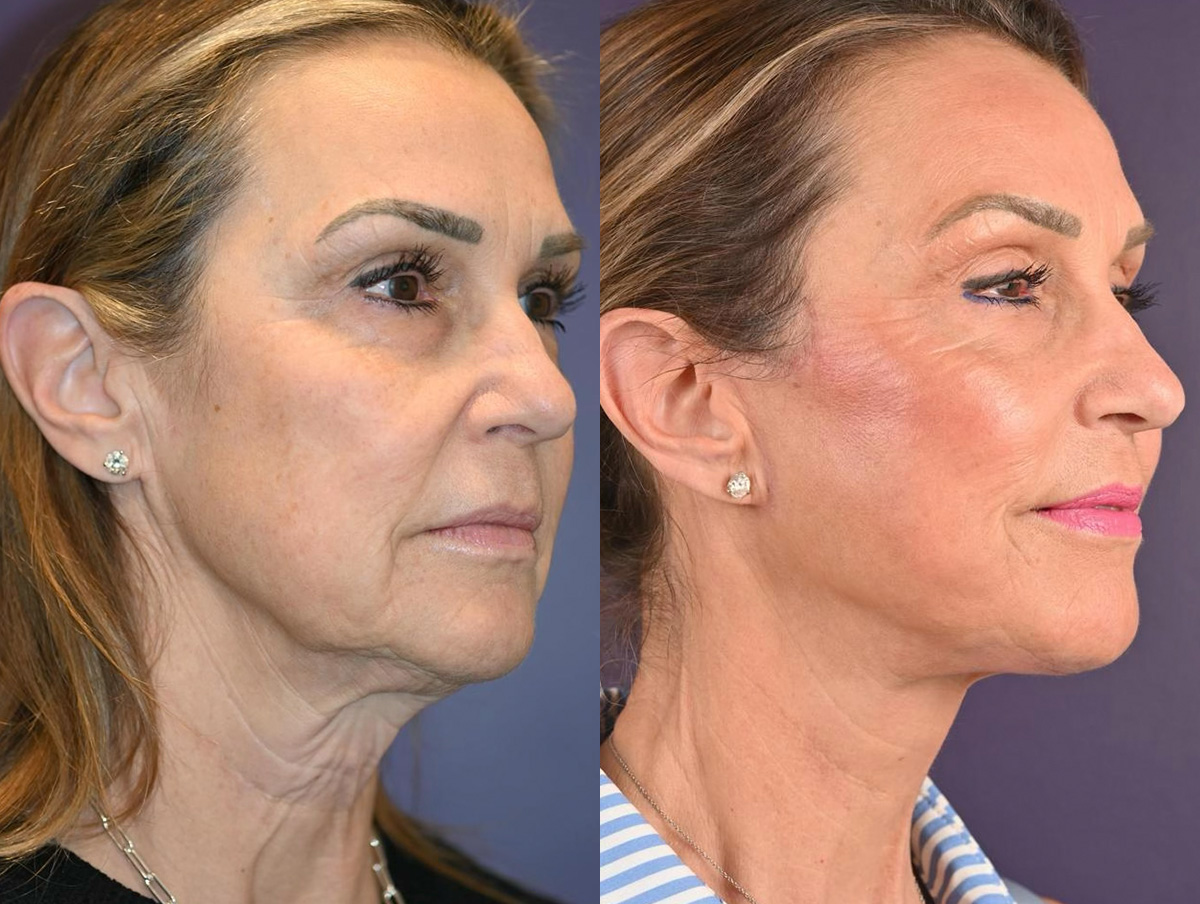 Office Facelift Before & After Gallery - Patient 198811 - Image 1