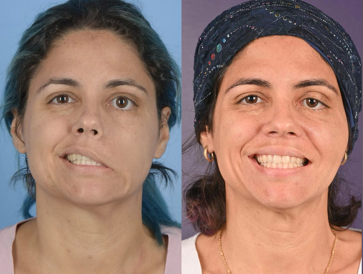 Gracilis Before & After Gallery - Patient 234775 - Image 1
