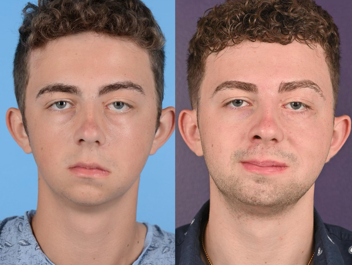 Static Suspension  Before & After Gallery - Patient 204796 - Image 1