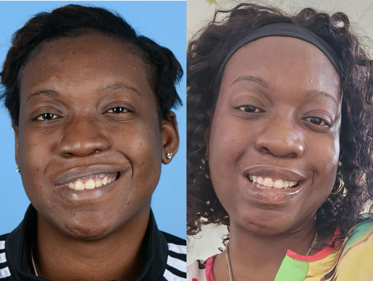 Denervation Before & After Gallery - Patient 945880 - Image 1