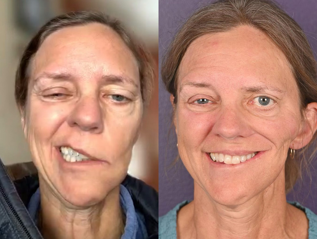 Gracilis Before & After Gallery - Patient 425501 - Image 1
