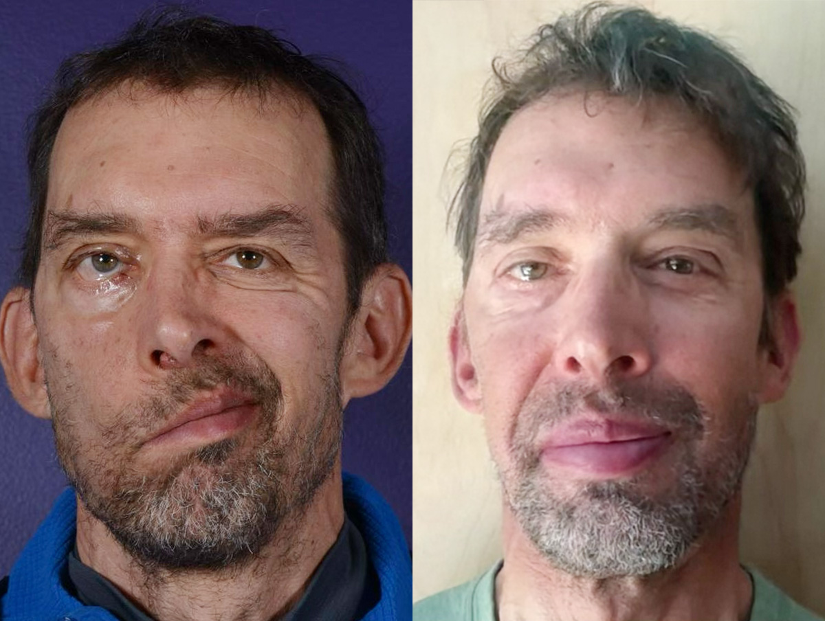 Static Suspension  Before & After Gallery - Patient 435858 - Image 1