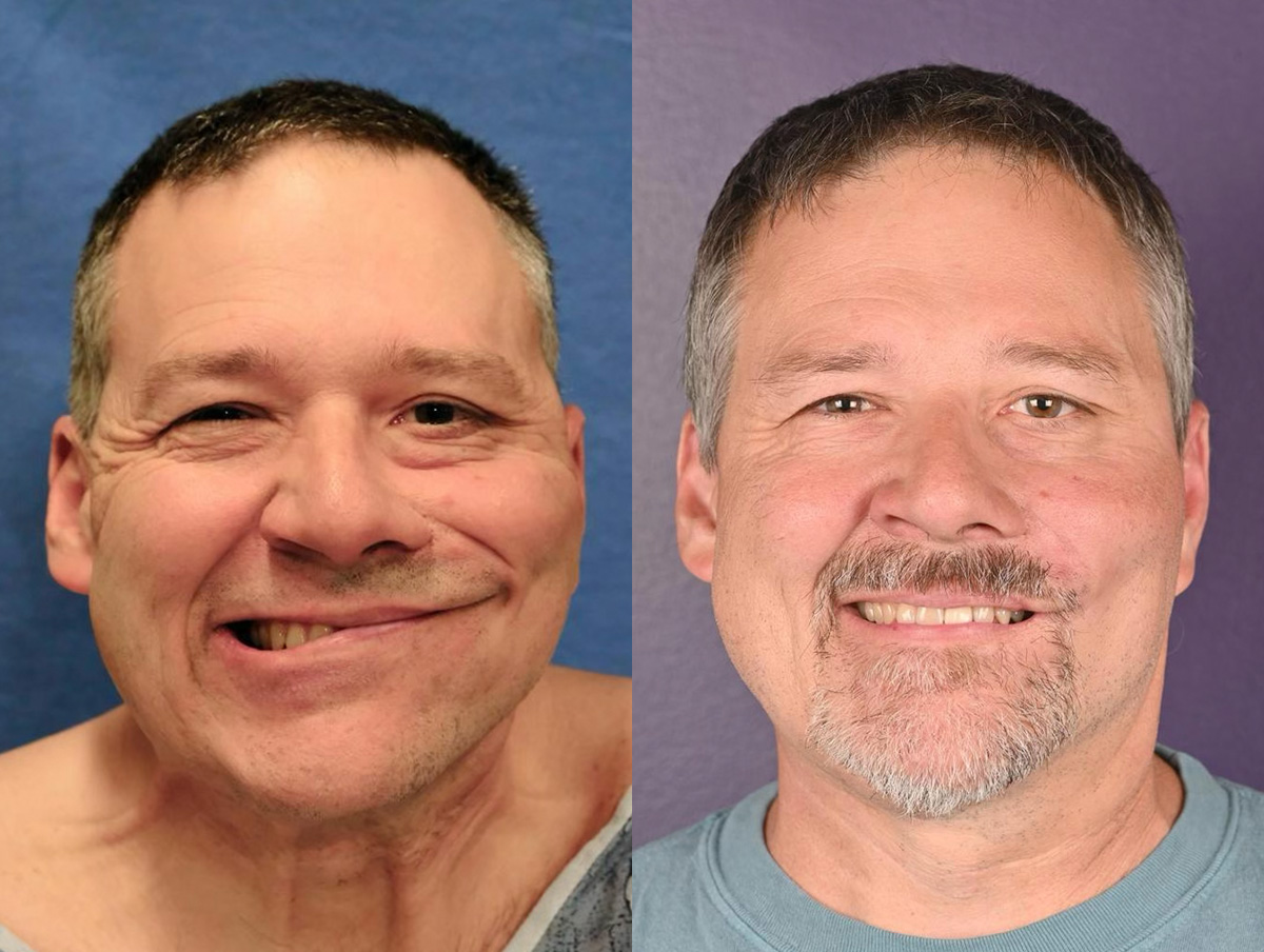 Muscle Resection: DAO, DLI, Ocular Myomectomy, Mentalis Before & After Gallery - Patient 264266 - Image 1