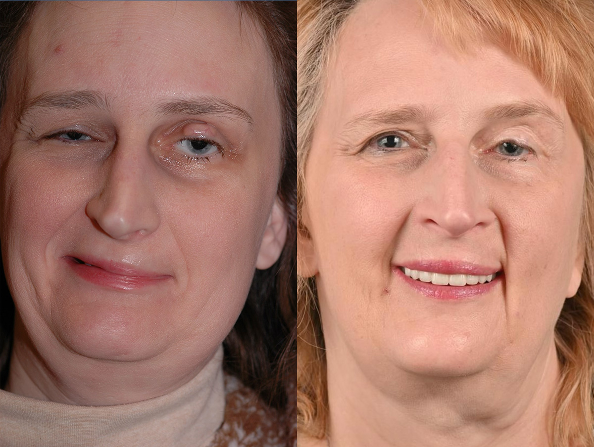 Gracilis Before & After Gallery - Patient 206118 - Image 1