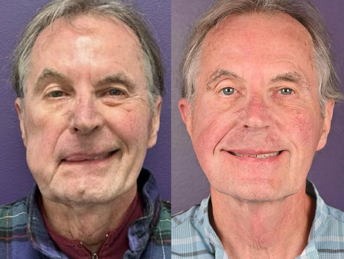 Gracilis Before & After Gallery - Patient 367105 - Image 1