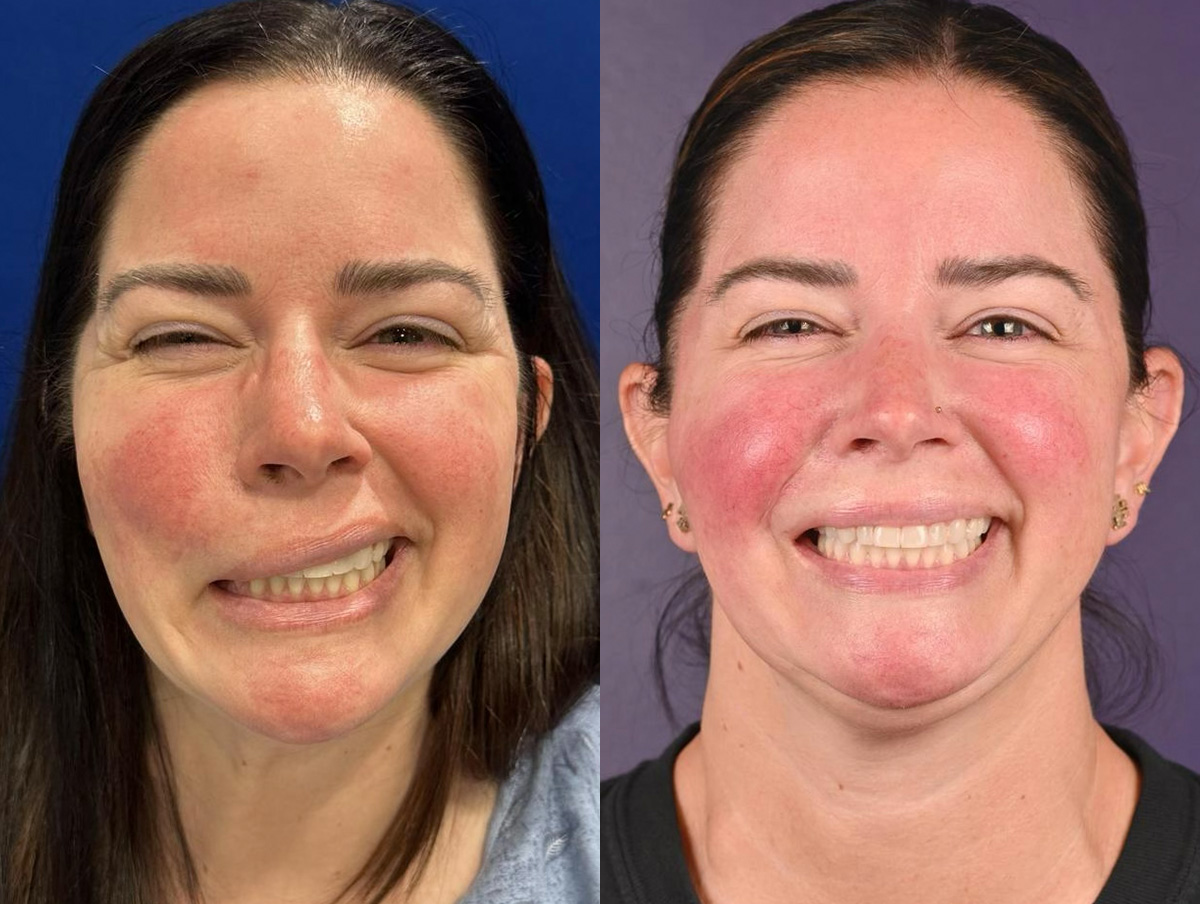 Gracilis Before & After Gallery - Patient 329438 - Image 1