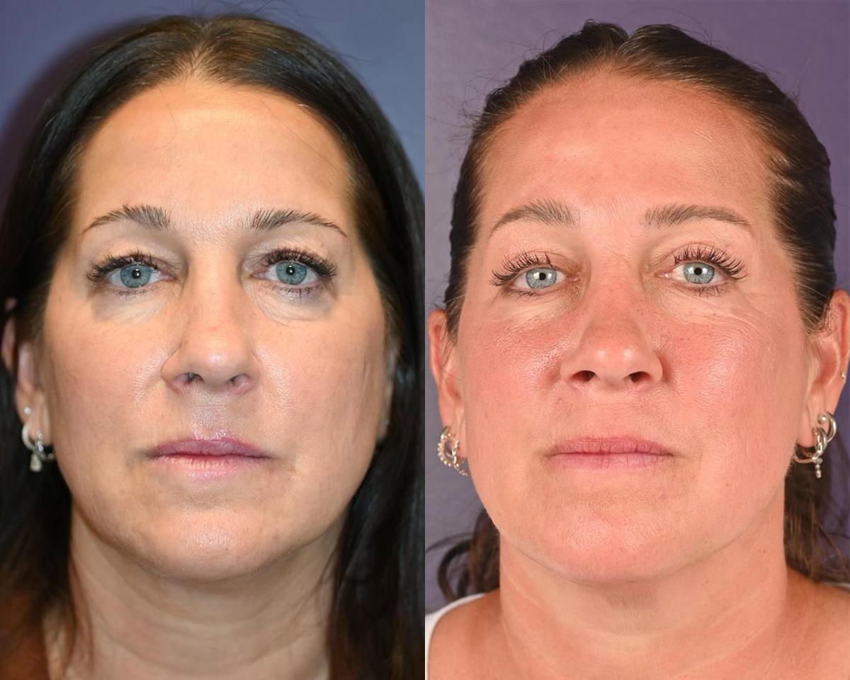 Blepharoplasty Before & After Gallery - Patient 298505 - Image 1