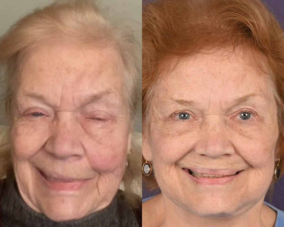 Denervation Before & After Gallery - Patient 327830 - Image 1