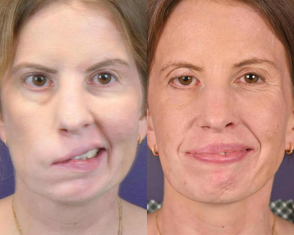 Reinnervation/Nerve Transfers Before & After Gallery - Patient 386208 - Image 1