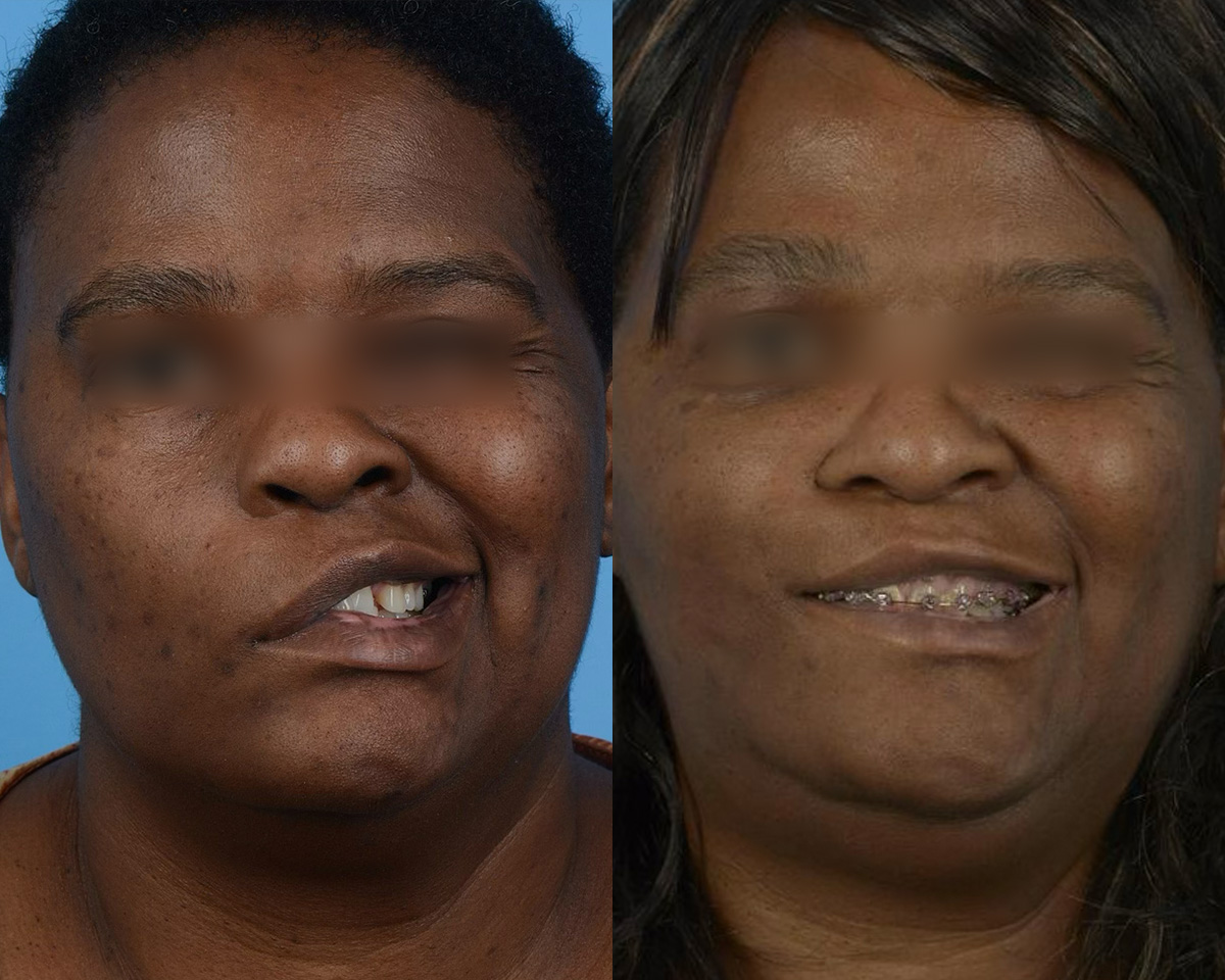 Gracilis Before & After Gallery - Patient 275514 - Image 1