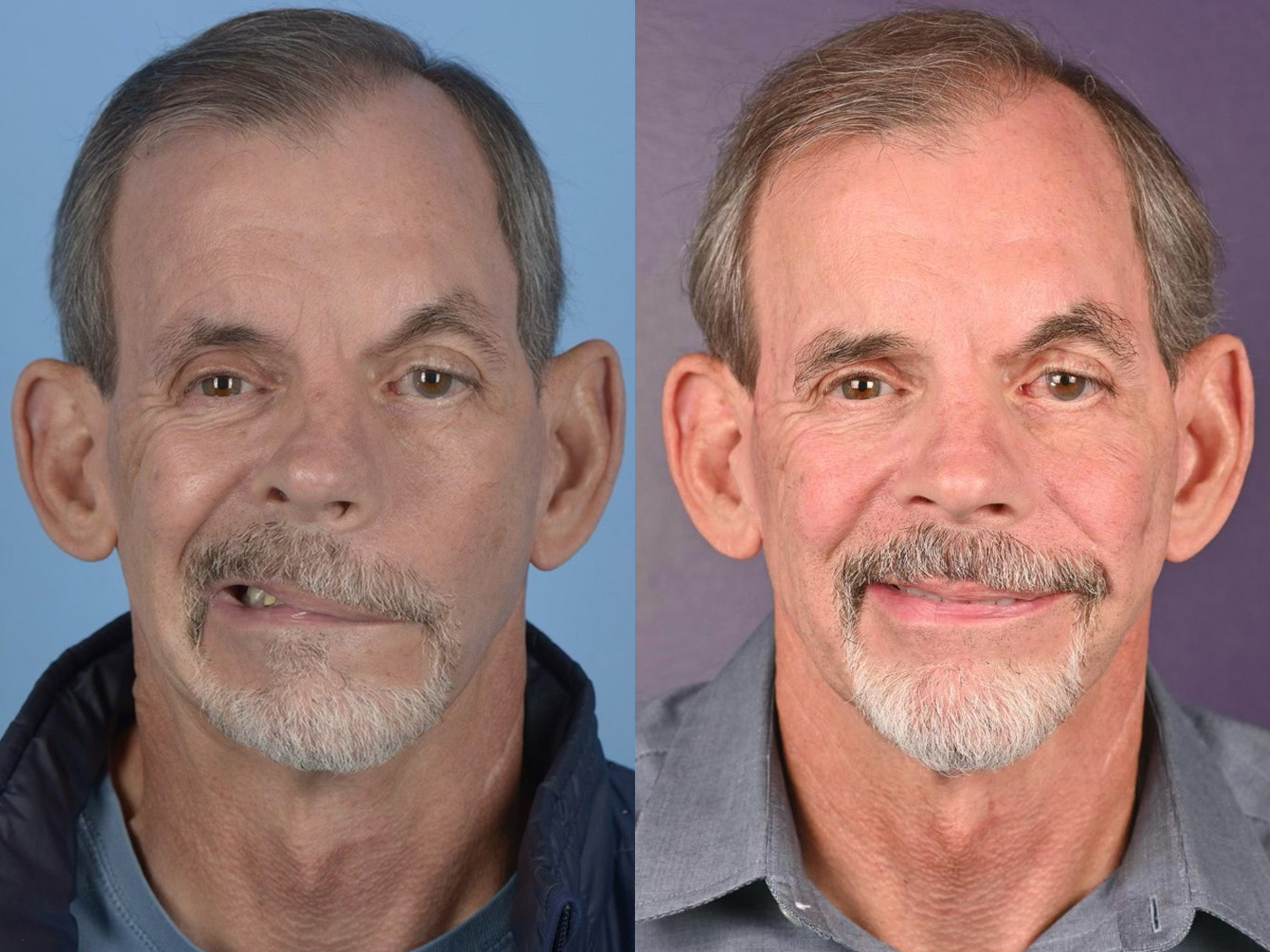 Gracilis Before & After Gallery - Patient 422724 - Image 1