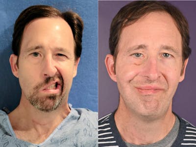 Gracilis Before & After Gallery - Patient 446615 - Image 1