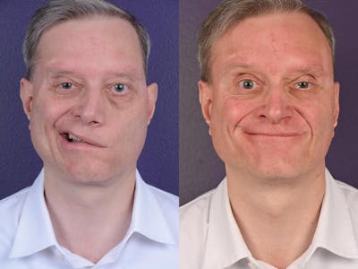 Facial Nerve Repair Before & After Gallery - Patient 641628 - Image 1