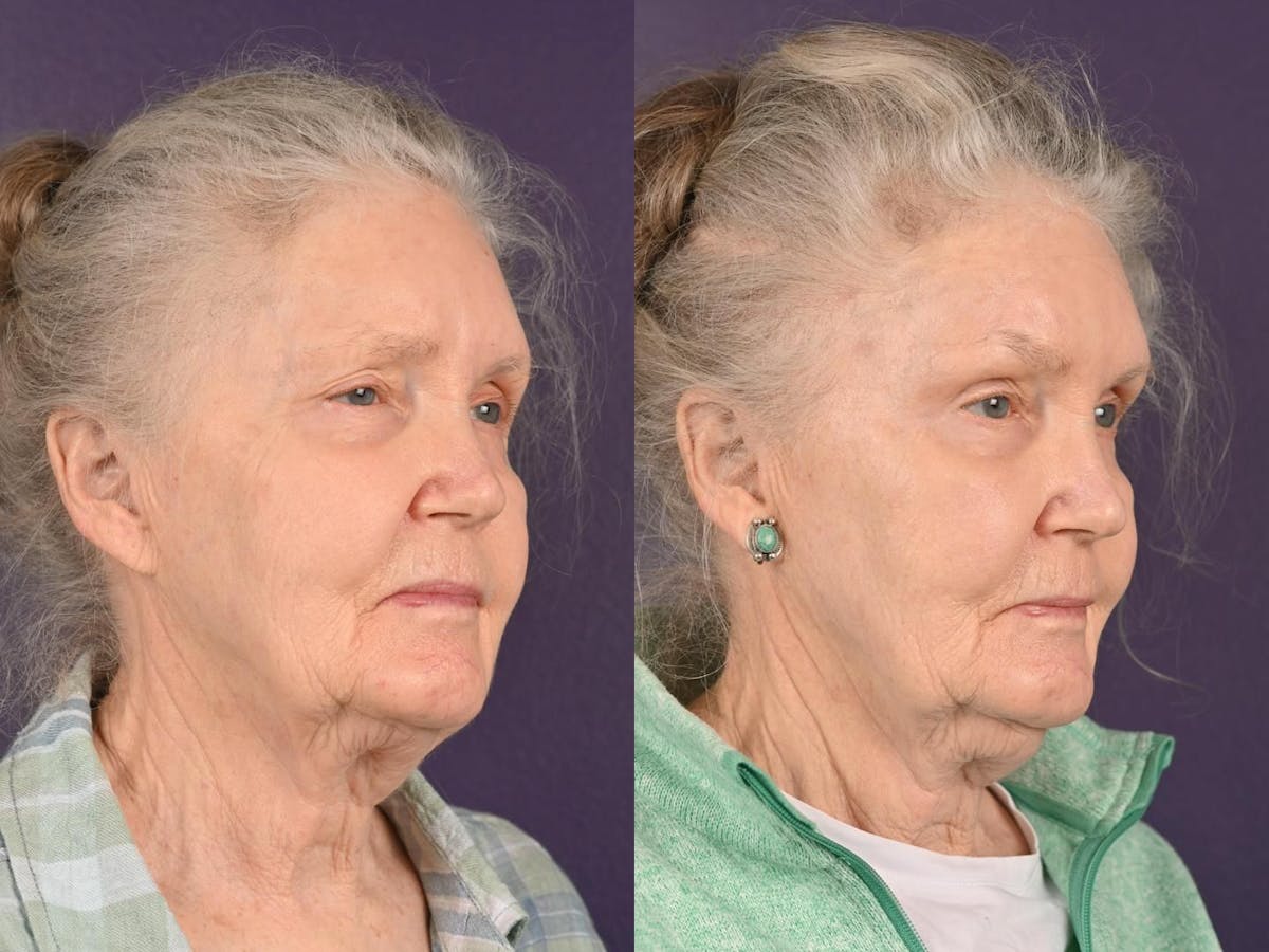 Blepharoplasty Before & After Gallery - Patient 976104 - Image 1
