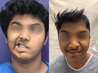 Reinnervation/Nerve Transfers Before & After Gallery - Patient 102354 - Image 1