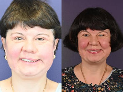 Facial Nerve Repair Before & After Gallery - Patient 280187 - Image 1