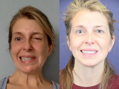 Denervation Before & After Gallery - Patient 288124 - Image 1