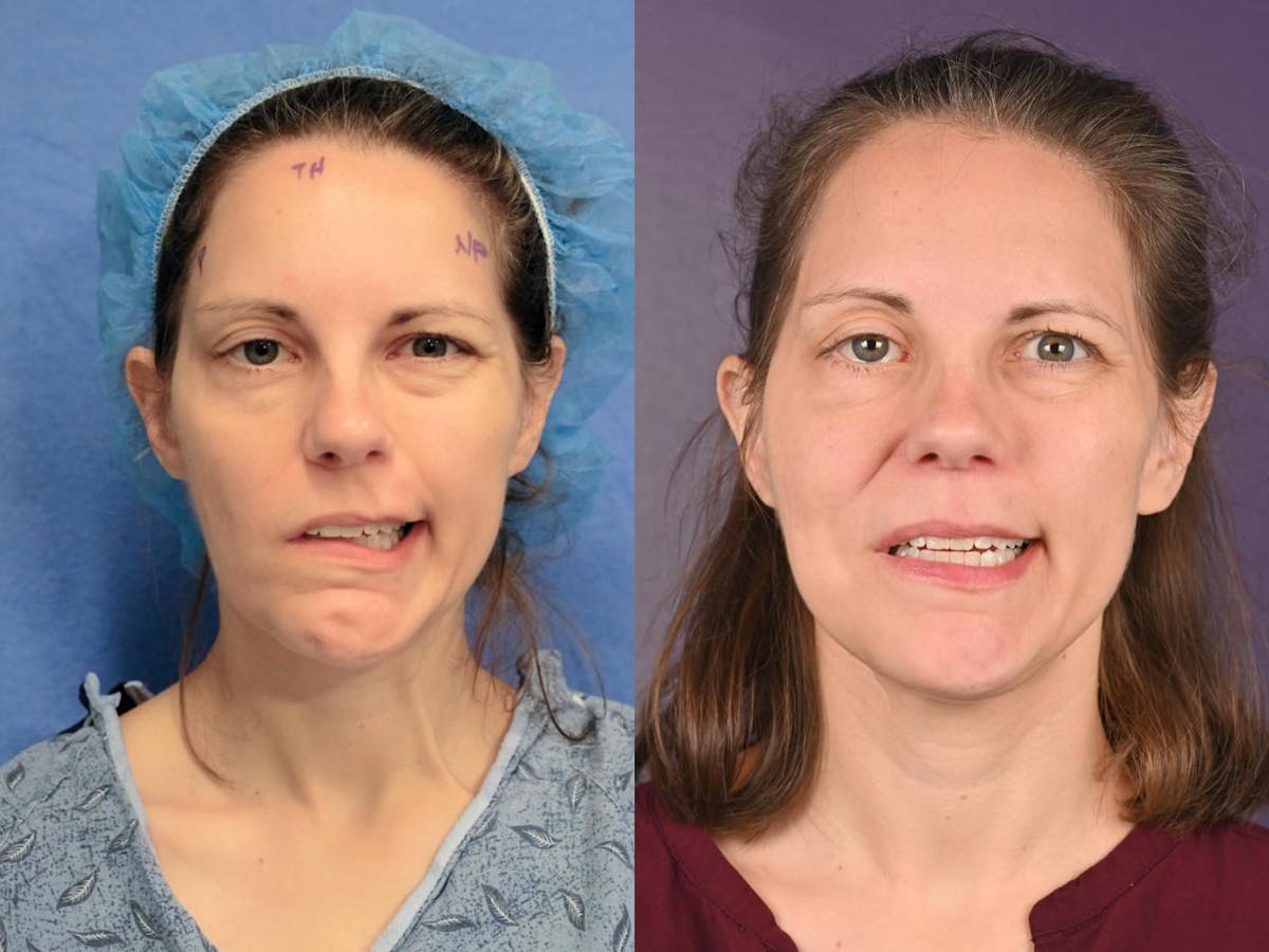 Facial Nerve Repair Before & After Gallery - Patient 428588 - Image 1
