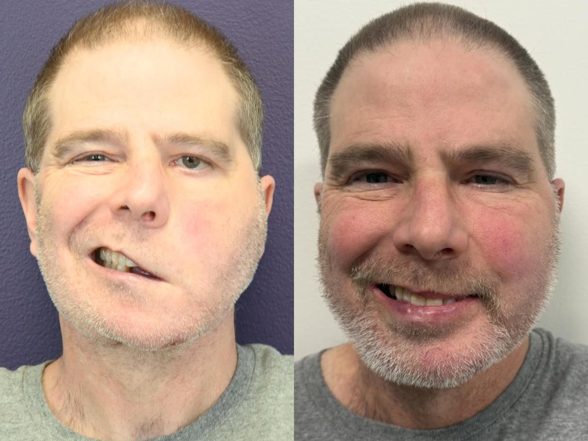 Facial Nerve Repair Before & After Gallery - Patient 378061 - Image 1