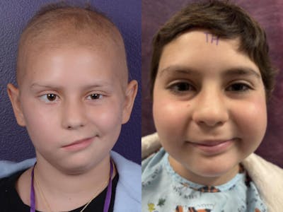 Reinnervation/Nerve Transfers Before & After Gallery - Patient 350729 - Image 1