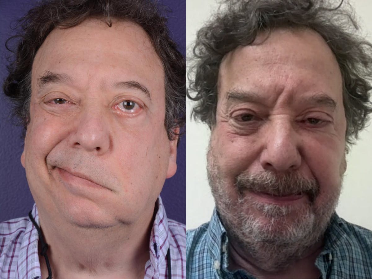 Reinnervation/Nerve Transfers Before & After Gallery - Patient 243973 - Image 1