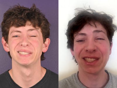 Denervation Before & After Gallery - Patient 131791 - Image 1