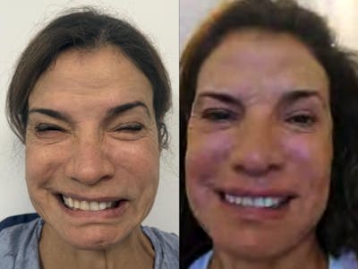 Denervation Before & After Gallery - Patient 208811 - Image 1