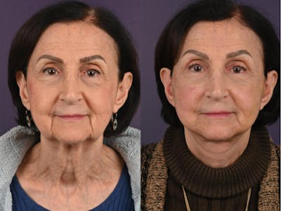 Office Facelift Before & After Gallery - Patient 184422 - Image 1