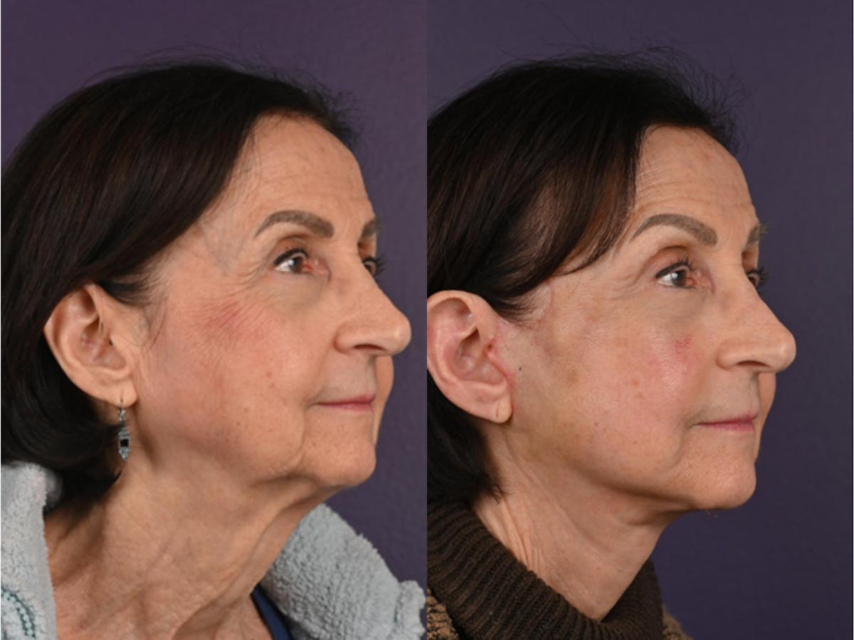 Office Facelift Before & After Gallery - Patient 184422 - Image 2