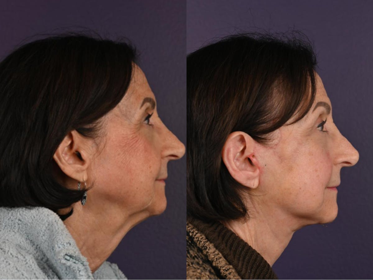 Office Facelift Before & After Gallery - Patient 184422 - Image 3