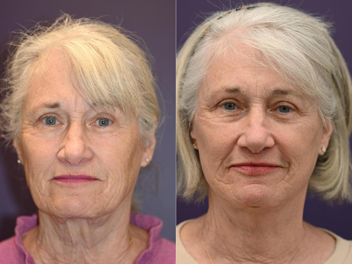 Office Facelift Before & After Gallery - Patient 183811 - Image 1
