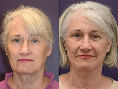 Office Facelift Before & After Gallery - Patient 183811 - Image 1