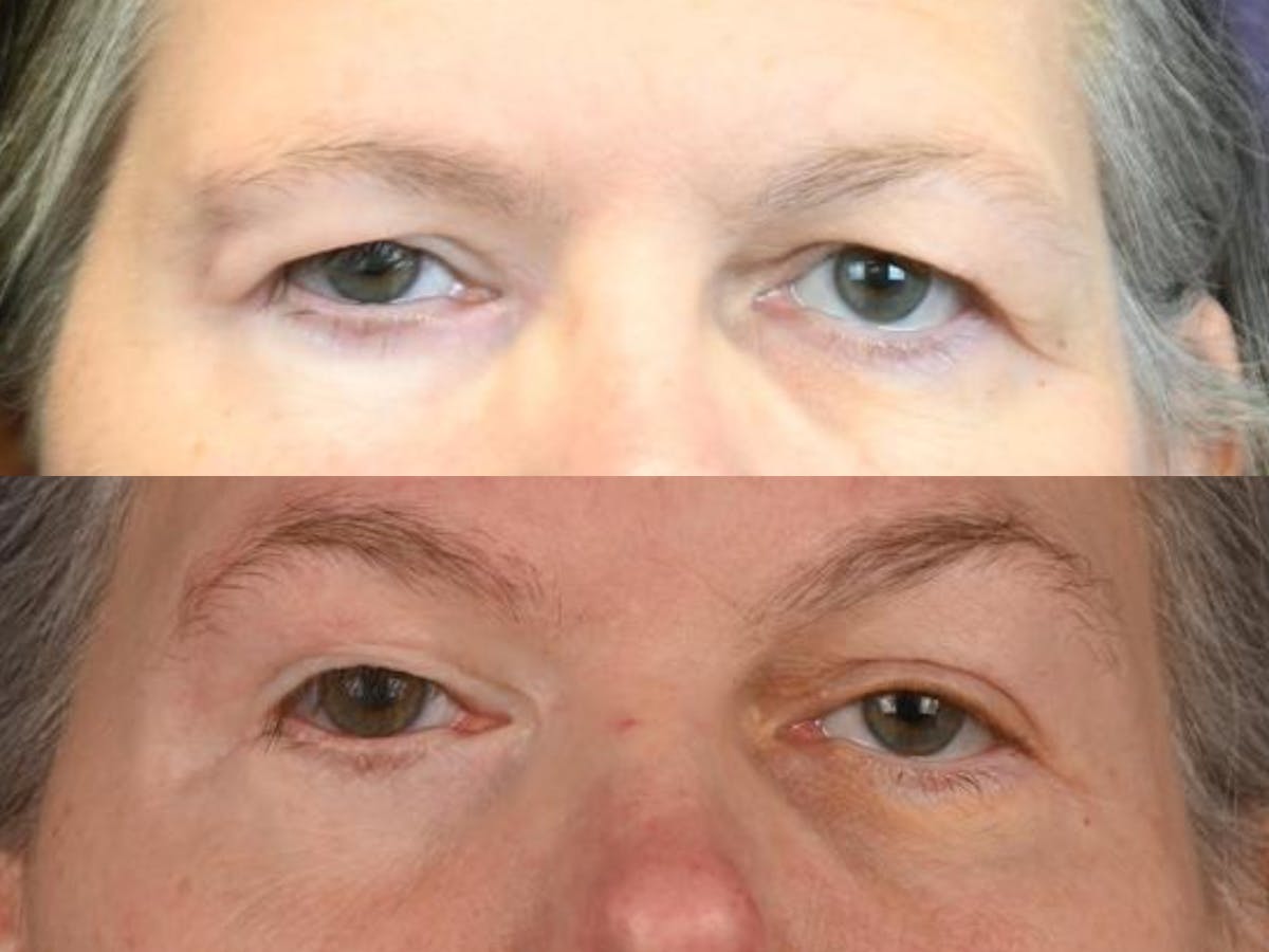 Blepharoplasty Before & After Gallery - Patient 360648 - Image 1
