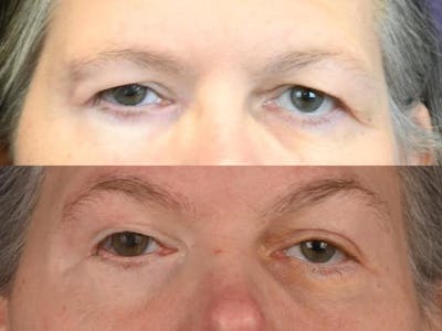 Blepharoplasty Before & After Gallery - Patient 360648 - Image 1