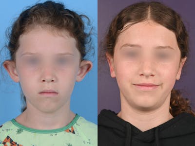 Otoplasty/Ear Pinning Before & After Gallery - Patient 133664 - Image 1
