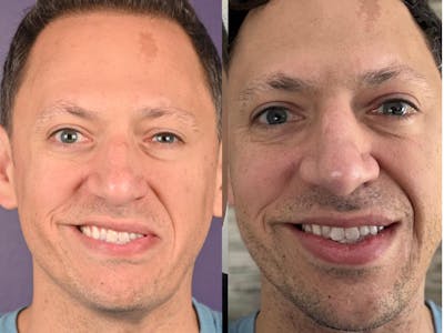 Denervation Before & After Gallery - Patient 261308 - Image 1