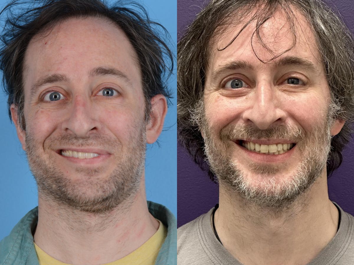 Denervation Before & After Gallery - Patient 133404 - Image 1