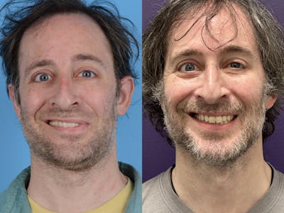 Denervation Before & After Gallery - Patient 133404 - Image 1
