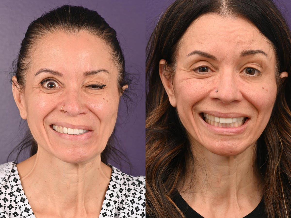 Denervation Before & After Gallery - Patient 363498 - Image 1