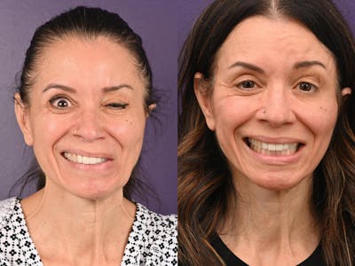 Denervation Before & After Gallery - Patient 363498 - Image 1