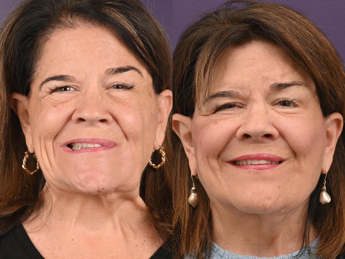 Denervation Before & After Gallery - Patient 133631 - Image 1
