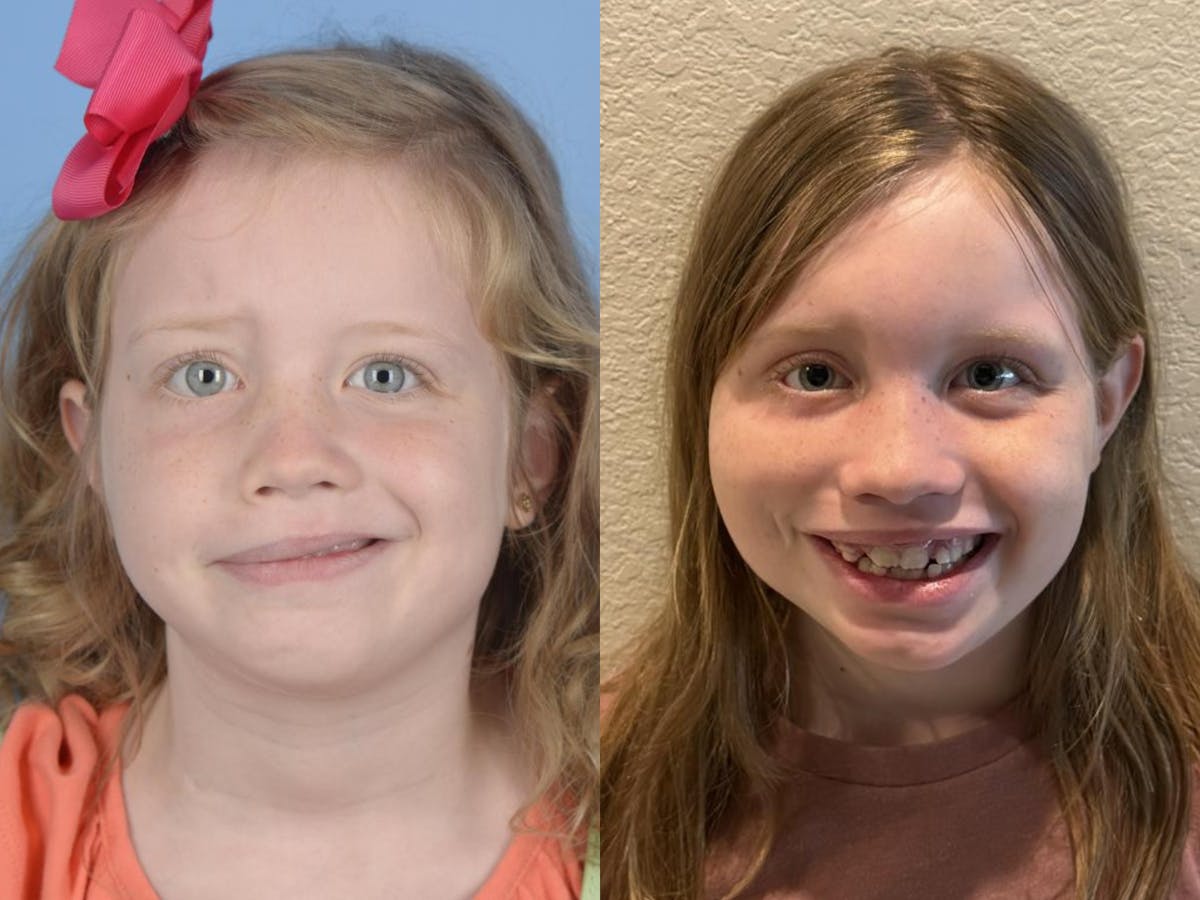 Gracilis Before & After Gallery - Patient 270572 - Image 1