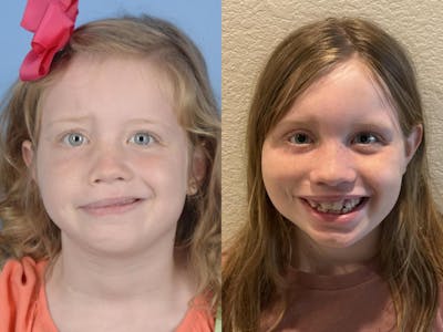 Gracilis Before & After Gallery - Patient 270572 - Image 1