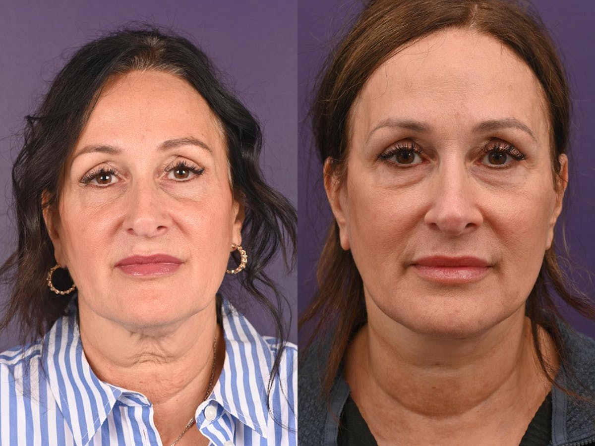 Office Facelift Before & After Gallery - Patient 210968 - Image 1